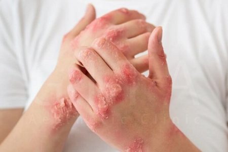 واقعیت پزشکی درباره بیماری مزمن پسوریازیس
